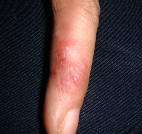 Herpetic Whitlow - Pictures, Symptoms, Treatment, Causes