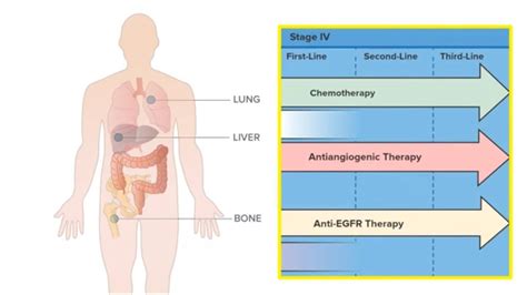 Metastatic Colorectal Cancer Prognosis - CancerWalls