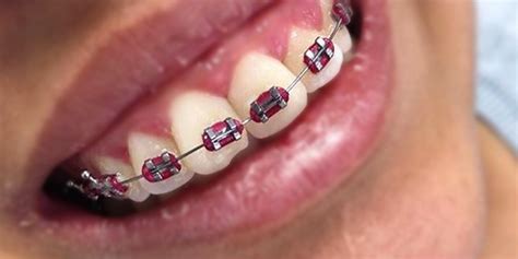 Top 10 colored of red braces for handsome teenage boys | Braces Explained