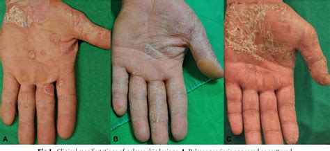 Figure 1 from The histopathological differentiation between palmar psoriasis and hand eczema: A ...