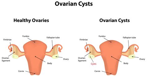 Ovarian Cysts: Are They Dangerous? | Your IVF Journey