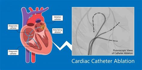 Catheter Ablation For AFib: Premier Cardiology Consultants: Cardiologists