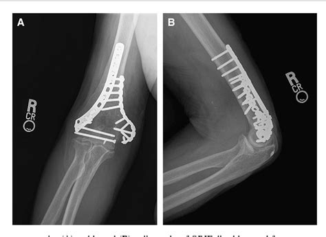 Distal Humerus Fracture