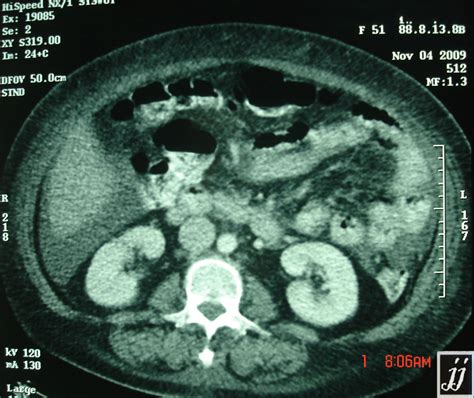 Anasarca edema, Ascites – Radiopaedia