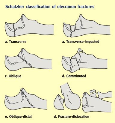 (iii) Proximal ulna fractures - Orthopaedics and Trauma