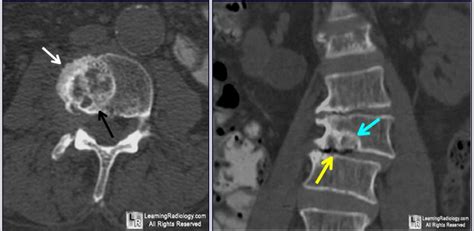 Schmorl's node. Black arrow points to well defined marginal lesion in L3 with sclerotic margins ...