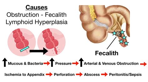 Appendicitis Pain: Symptoms, Signs, Causes, Diagnosis, Treatment — EZmed