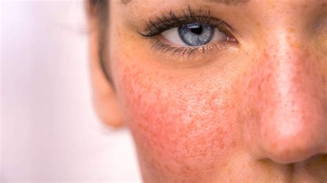 Itch or Non-Itchy Red Face Rash Causes and Treatments - American Celiac
