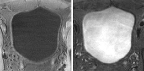 Illustration of bladder MRI, (a) T1-weighted and (b) T2-weighted images. | Download Scientific ...