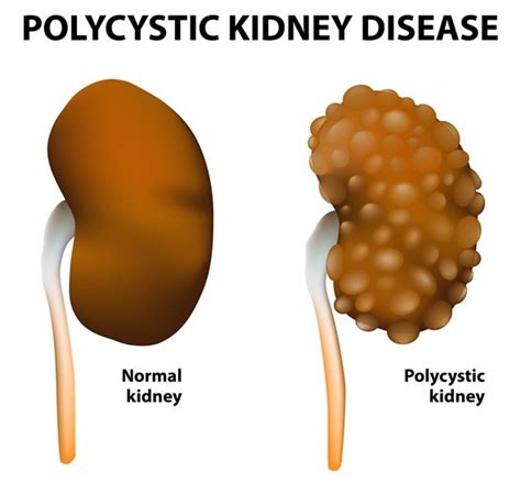 Polycystic Kidney Disease (PKD) Overview