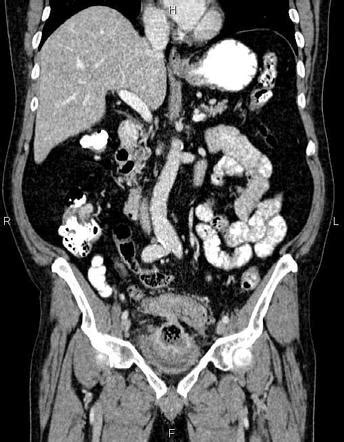 Bladder cancer | Radiology Reference Article | Radiopaedia.org