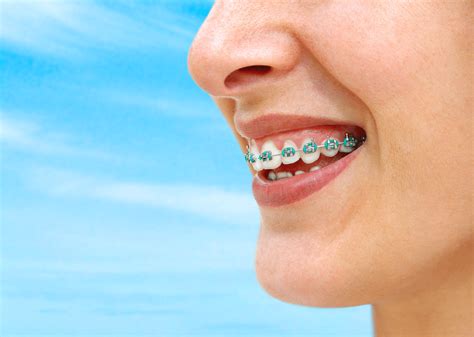 Average Cost Of Braces - DR. LINTS ORTHODONTICS