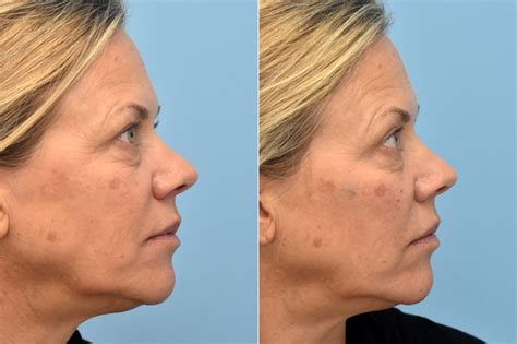 Injectable Fillers photos | Philadelphia, PA | Patient 1325