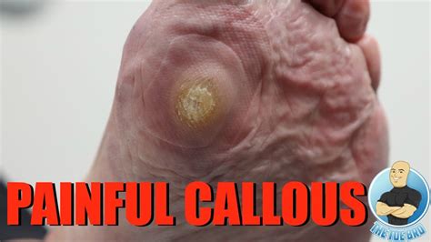 HUGE PAINFUL CALLOUS REMOVAL ***AND HOW TO STOP IT FROM GROWING***