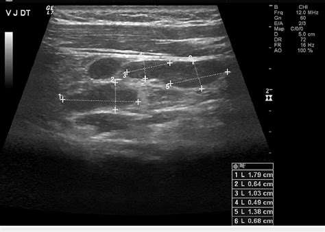 Cervical ultrasound of the patient The cervical ultrasound showed ...