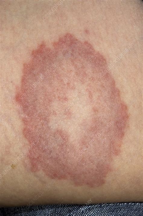 Granuloma annulare on the skin - Stock Image - C002/9593 - Science Photo Library