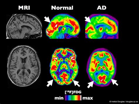 Neuroimaging: Three important brain imaging techniques – ScIU