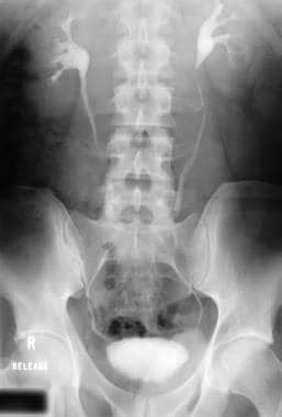 Retroperitoneal Fibrosis: Practice Essentials, Background, Pathophysiology