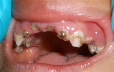 Rotten Teeth Pictures and Treatments | New Health Advisor