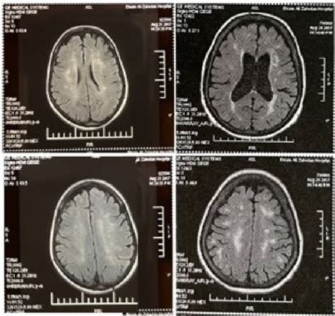 Subcortical, and periventricular white matter abnormality in long-term ...