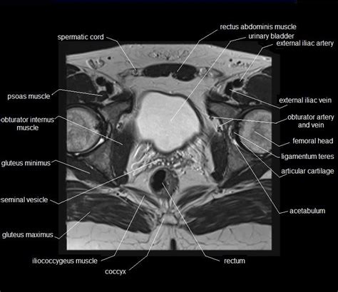 Pelvis Muscles Mri Anatomy Mri Female Pelvis Anatomy Axial Image 1 ...