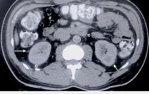 CT scan shows mild bilateral perinephric fat stranding (arrows). | Download Scientific Diagram