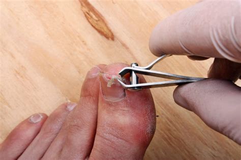 How To Fix A Dead Toenail: A 4-Step Ultimate Guide