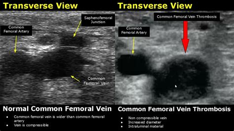 Femoral Vein Doppler Ultrasound Normal Vs Abnormal Image Appearances ...