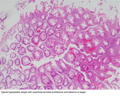 Colon Polyp Histology