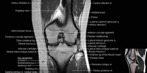 MRI Knee Anatomy | Knee mri, Mri, Meniscus tear