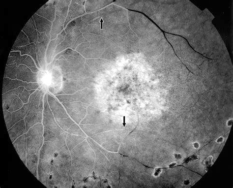 Occlusive Retinal Vasculitis Associated With Systemic Lupus ...