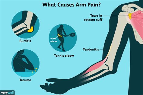 Arm Pain: Causes, Treatment, and When to See a Doctor