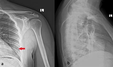 Characteristics, Management, and Outcomes of Inferior Scapula Angle Fractures: A Systematic ...