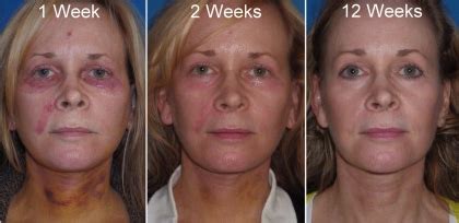 Facelift Richmond | Face Lift | Neck Lift Richmond VA | Cosmetic Facial Plastic Surgery