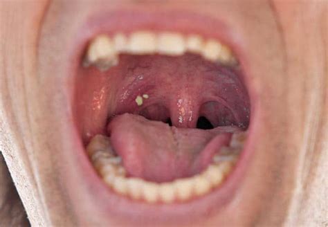 what do Tonsil stones look like in the throat? The 5 Variations