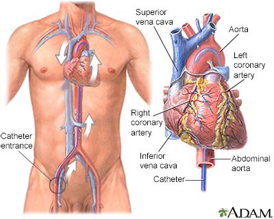 Cardiac catheterization Information | Mount Sinai - New York