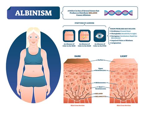 Albinism | Eye Patient