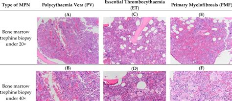 Bone marrow trephine biopsy of classical BCR-ABL-negative MPN under 20×... | Download Scientific ...