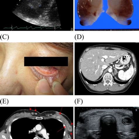 Figure1.Clinical symptoms indicating Carney complex. (A) Cardiac myxoma... | Download Scientific ...