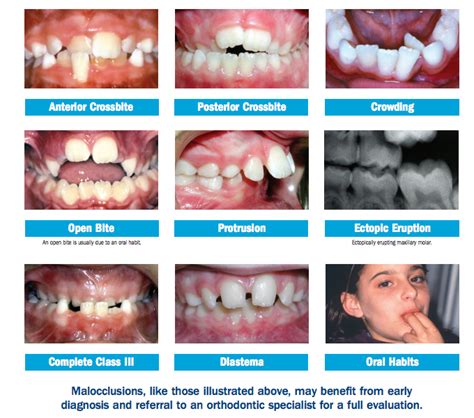 Crossbites - Vac Orthodontics