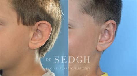 Ear Pinning Surgery Before and After Photos | Dr. Sedgh