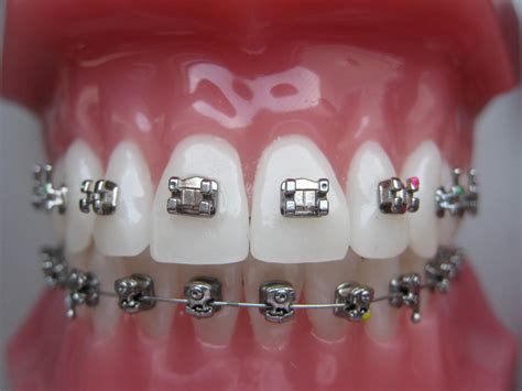 Fixed orthodontic appliances - Specialized dental studio “Aponija ...