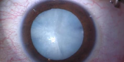 White Cataracts: Recognition, Diagnosis, and Treatment | Ophthalmology Education