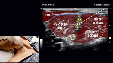 How To Ultrasound Guided Interscalene Nerve Block 3d Video – Otosection