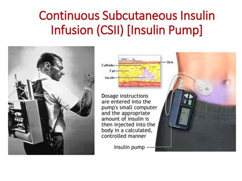 Reimbursement of Continuous Subcutaneous’ Insulin Infusion (CSII) Pump Therapy’ under CGHS/CS(MA ...