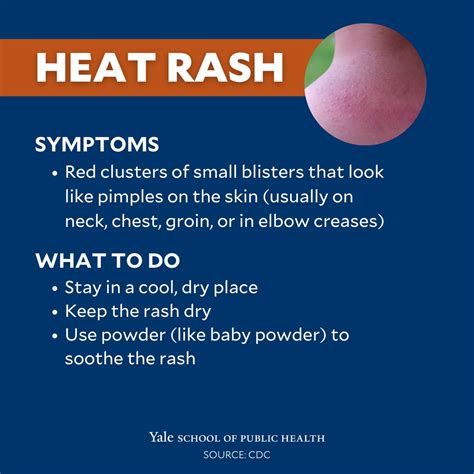 Yale School of Public Health on Twitter: "HEAT RASH:"