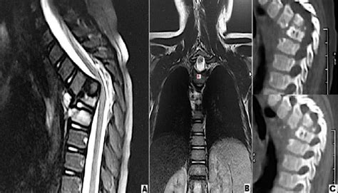 Case's preoperative MRI demonstrated a large paraspinal abscess and... | Download Scientific Diagram