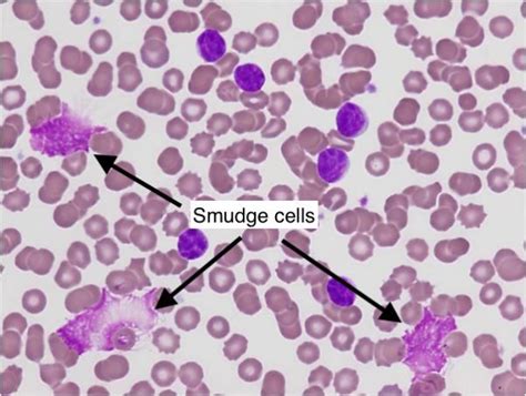 Chronic Lymphocytic Leukemia (CLL)/Small Lymphocytic Lymphoma (SLL ...