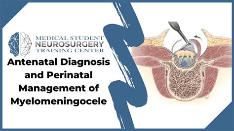 Antenatal Diagnosis and Perinatal Management of Myelomeningocele - YouTube