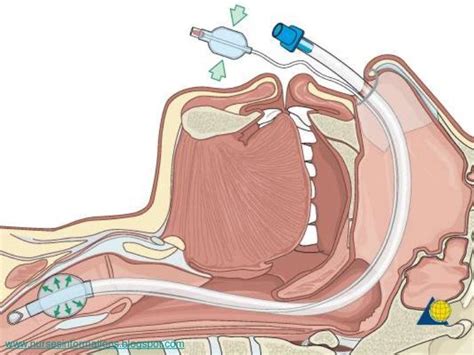 Neurological Assessment & Artificial Airway Management